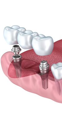 Coroană dentară pe implant