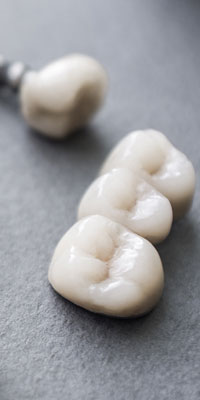 Coroană dentară ceramică presată