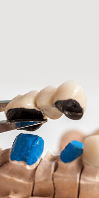Coroană dentară metaloceramică semifizionomică